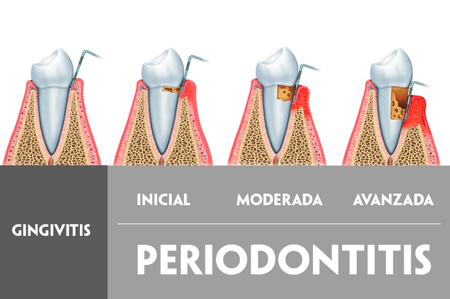 imagen periodontitis