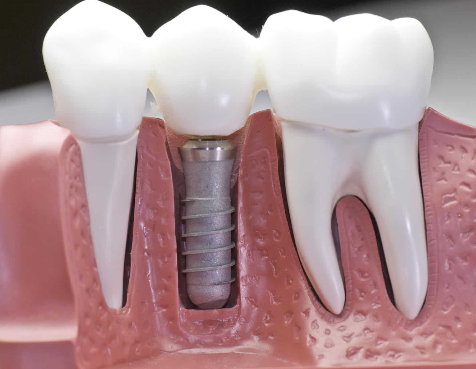 imagen implante dental